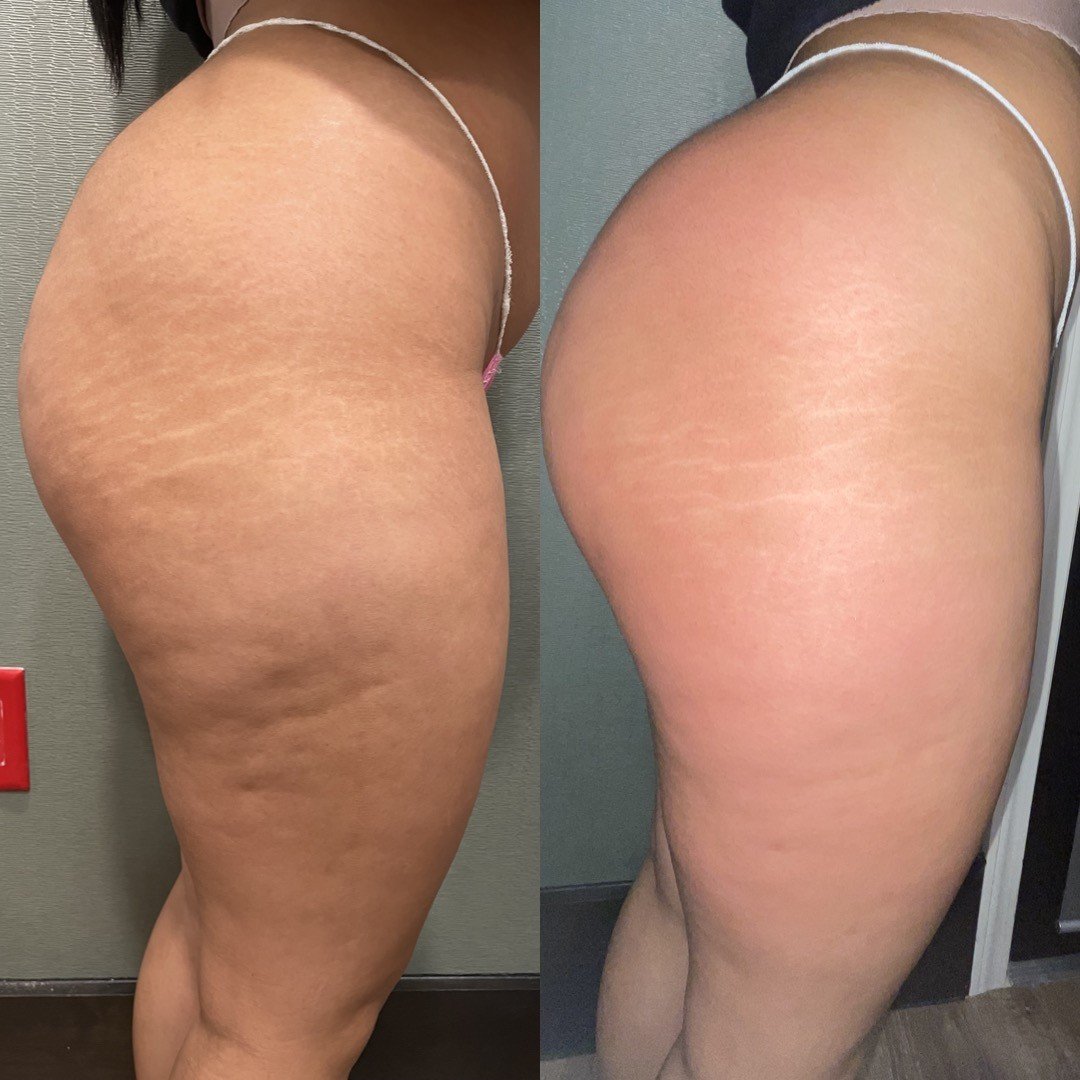 CelluClear Treatment